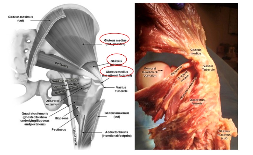 Femoral Intramedullary Nailing - How To Choose The Best Insertion Point-1 Бедренный интрамедуллярный гвоздь – как выбрать лучшую точку введения-1