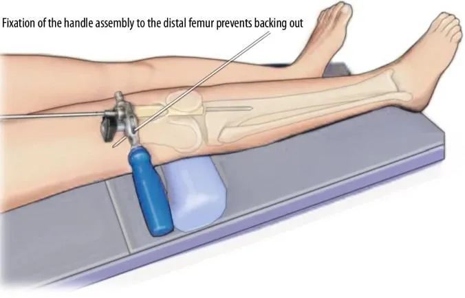 Tibial fractures, suprapatellar intramedullary nail technique-12 Переломы большеберцовой кости, супрапателлярная интрамедуллярная техника стержня-12