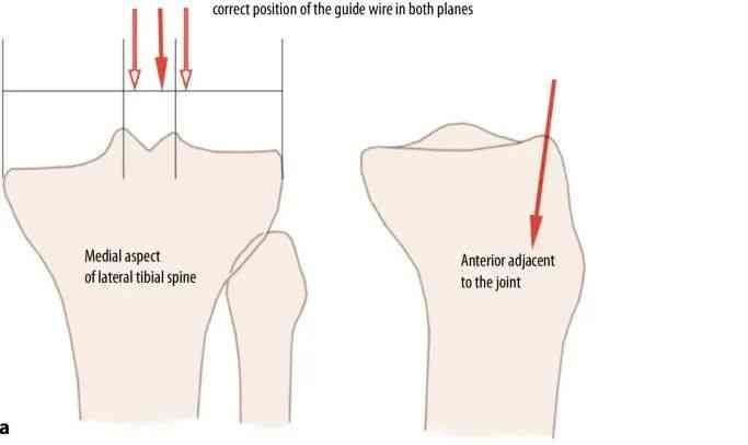 Tibial fractures, suprapatellar intramedullary nail technique-10 Переломы большеберцовой кости, супрапателлярная интрамедуллярная техника стержня-10