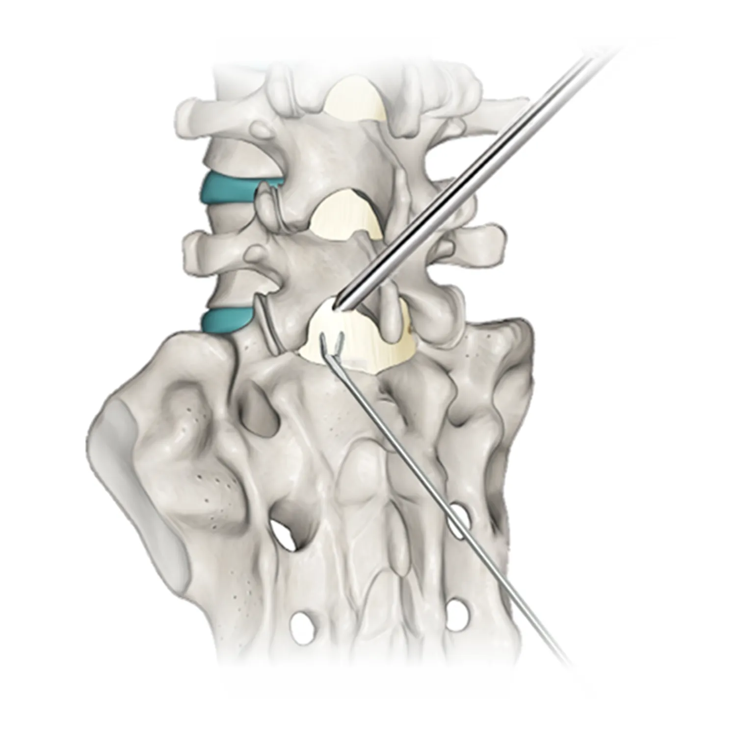 Orthopedic Spinal Implants Types Materials and Manufacturing Trends Типы ортопедических спинальных имплантатов, материалы и тенденции производства