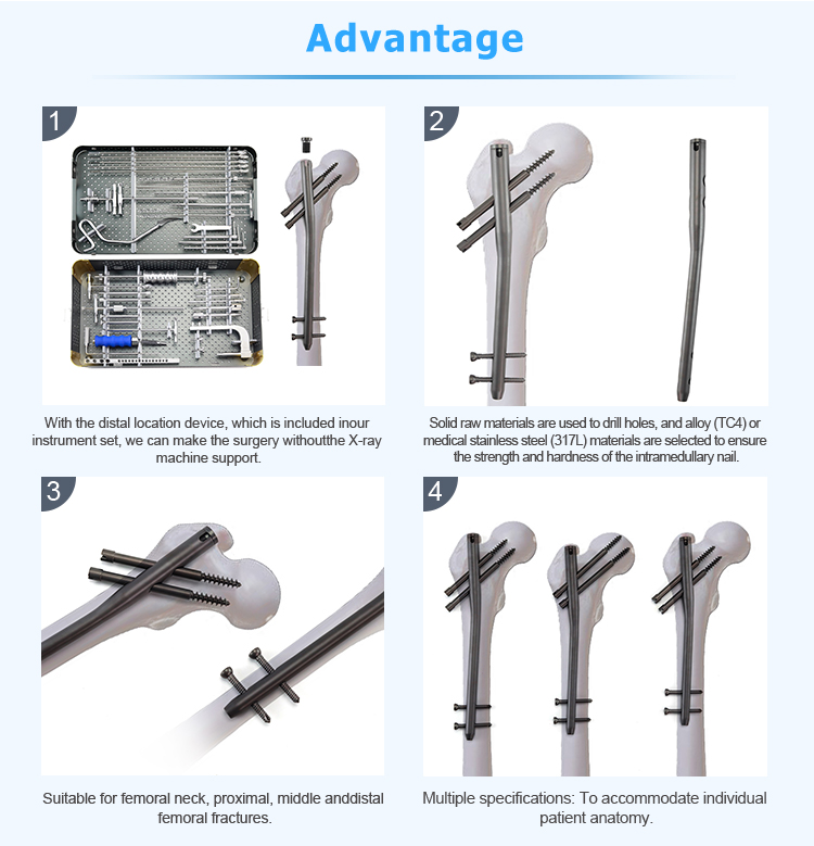 Titanium Gamma Nail | Proximal Femoral Fracture Fixation Implants - XC Medico - 3 Титановых гамма-гвоздя | Имплантаты для фиксации проксимального перелома бедренной кости — XC Medico — 3