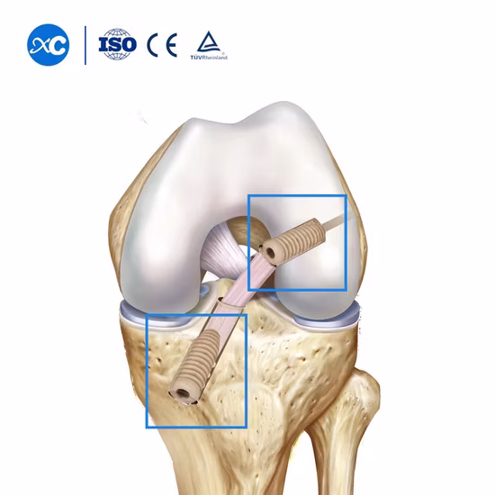 Шовный анкерный винт из PEEK (ACL/PCL)