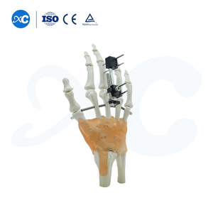 Внешняя фиксация пястных костей и фаланг