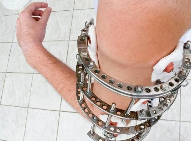 Баннер внешней фиксации-3