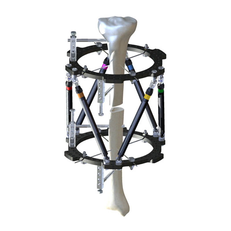 Внешняя фиксация