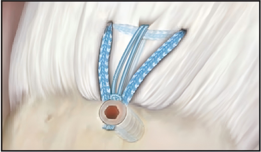 Шовная лента при восстановлении вращательной манжеты плеча