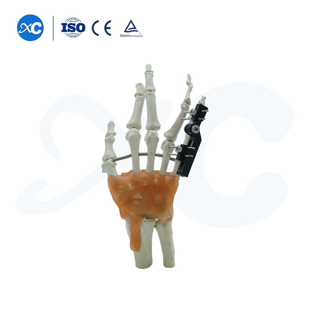 Внешняя фиксация пястных костей и фаланг