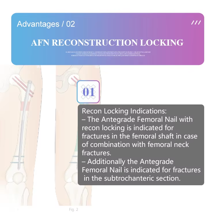Реконструкция бедренной кости Интрамедуллярный стержень-3