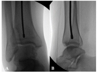 Техника фиксации интрамедуллярных гвоздей большеберцовой кости-10