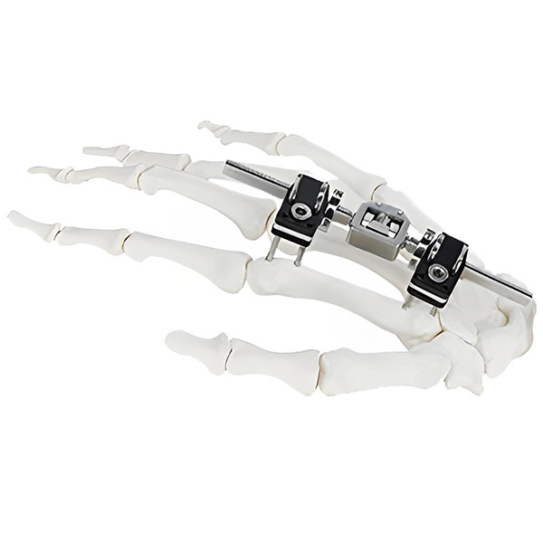 Мини-фрагмент-внешний фиксатор