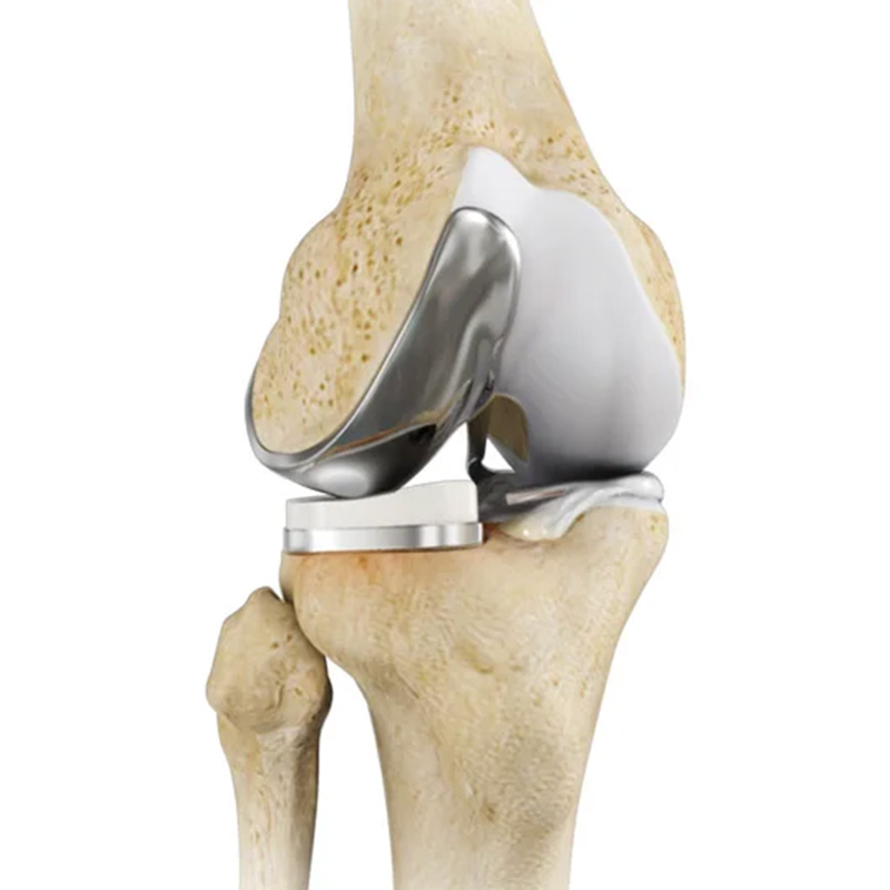 Протез коленного сустава