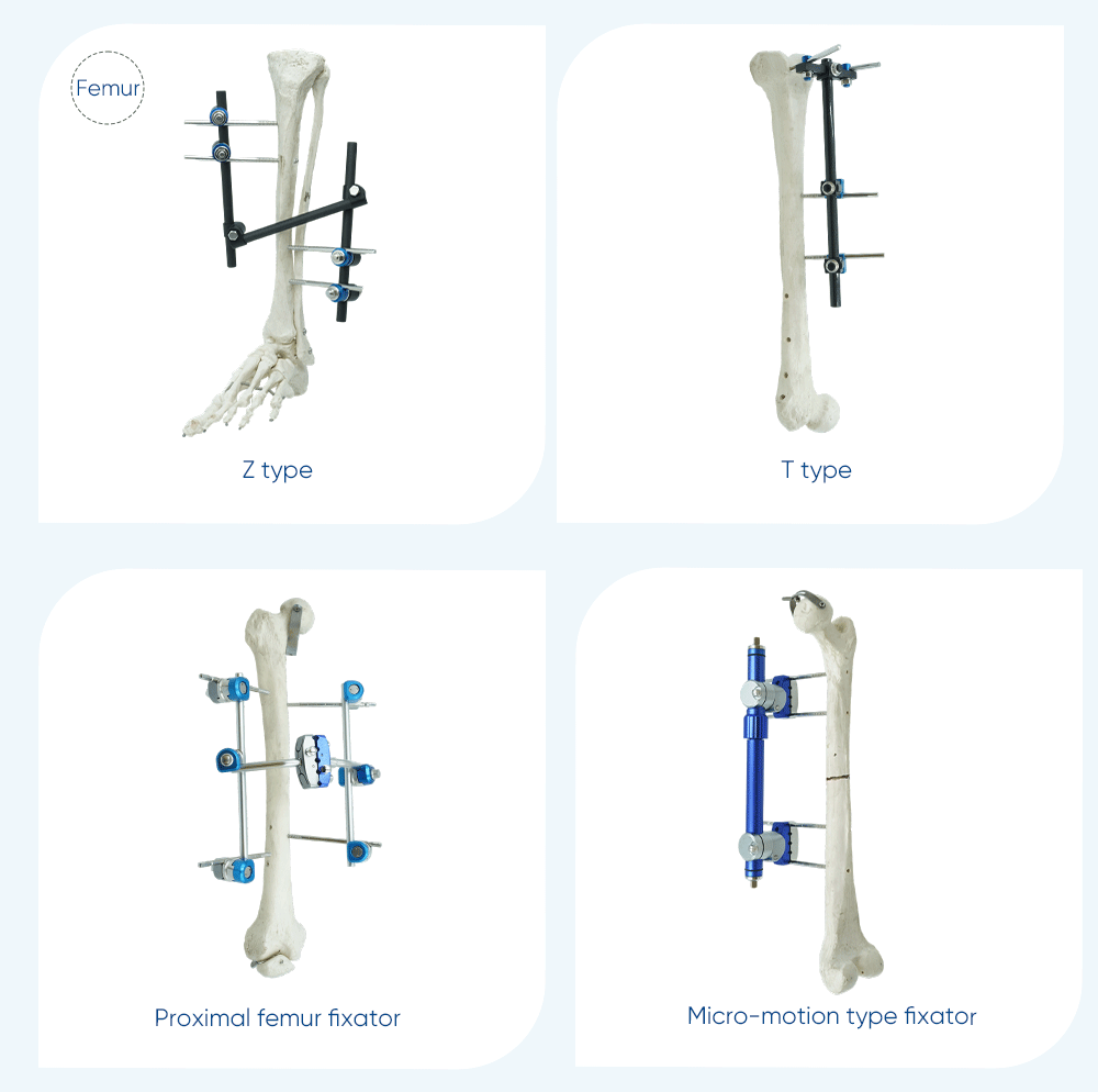  Внешний фиксатор для ноги — покупка продукта на XC Medico Внешний фиксатор для ноги — 