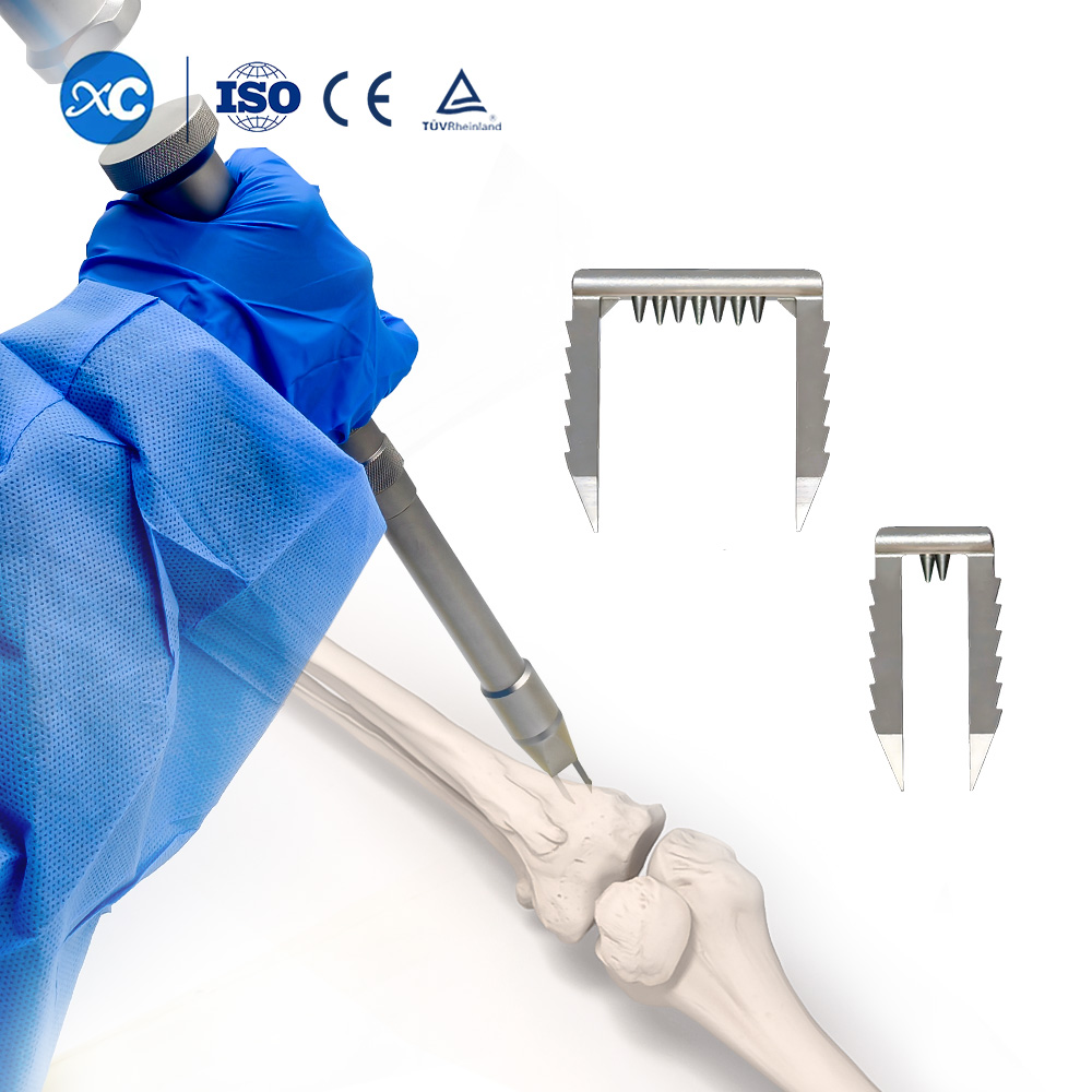 Степлерная система для фиксации связок – реконструкция передней крестообразной связки