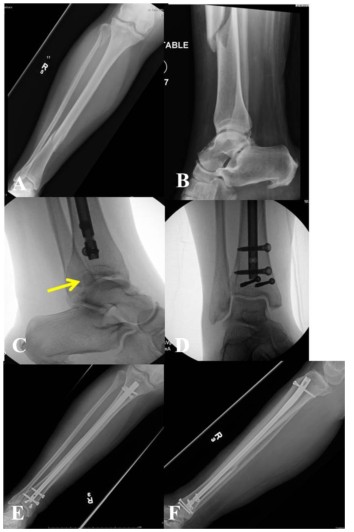 Техника фиксации интрамедуллярных гвоздей большеберцовой кости-1