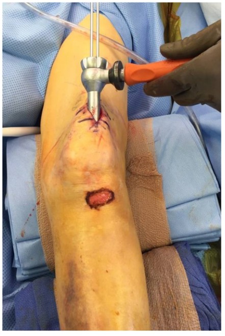 Техника фиксации интрамедуллярных гвоздей большеберцовой кости-4