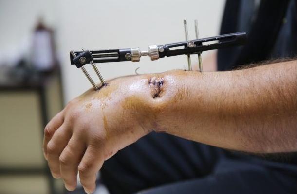 Баннер внешней фиксации-2