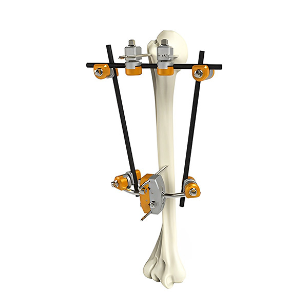 Внешний фиксатор малых фрагментов