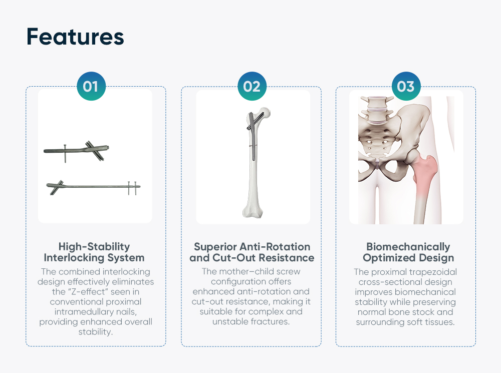 Система интрамедуллярных стержней Intertan – фиксация перелома проксимального отдела бедренной кости 