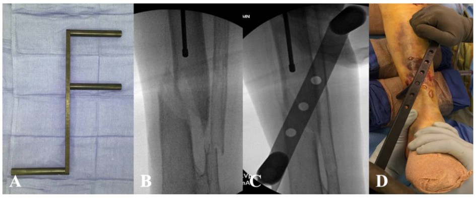 Техника фиксации интрамедуллярных гвоздей большеберцовой кости-5