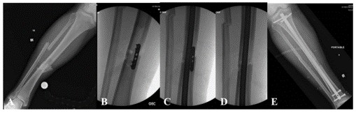 Техника интрамедуллярной фиксации гвоздей на большеберцовой кости