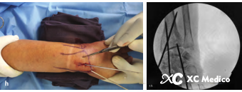 Дистальный радиус переломы-21