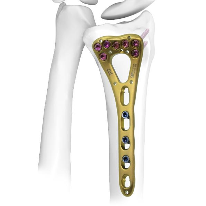 Система запирающих пластин