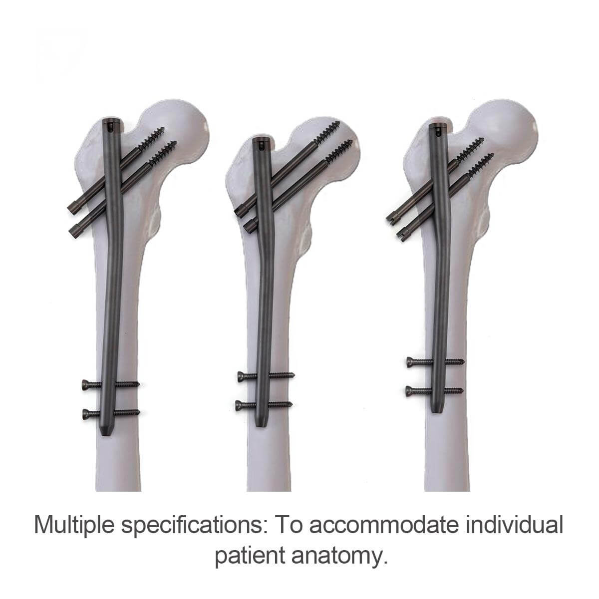 Гамма-интрамедуллярный гвоздь-4