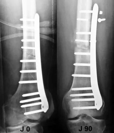 Запирающая пластина – Ограничения и ограничения по применению – 5