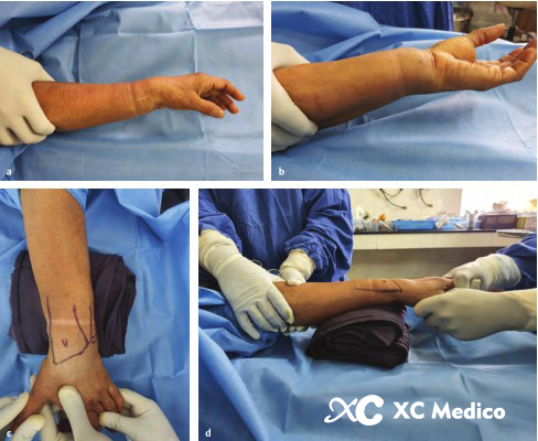 Дистальный радиус переломы-2