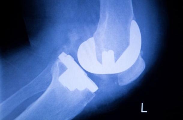 Тазобедренный и коленный суставы-1