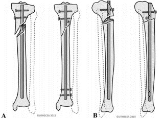 Техника фиксации интрамедуллярных гвоздей большеберцовой кости-9