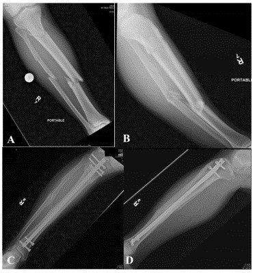 Техника фиксации интрамедуллярных гвоздей большеберцовой кости-12