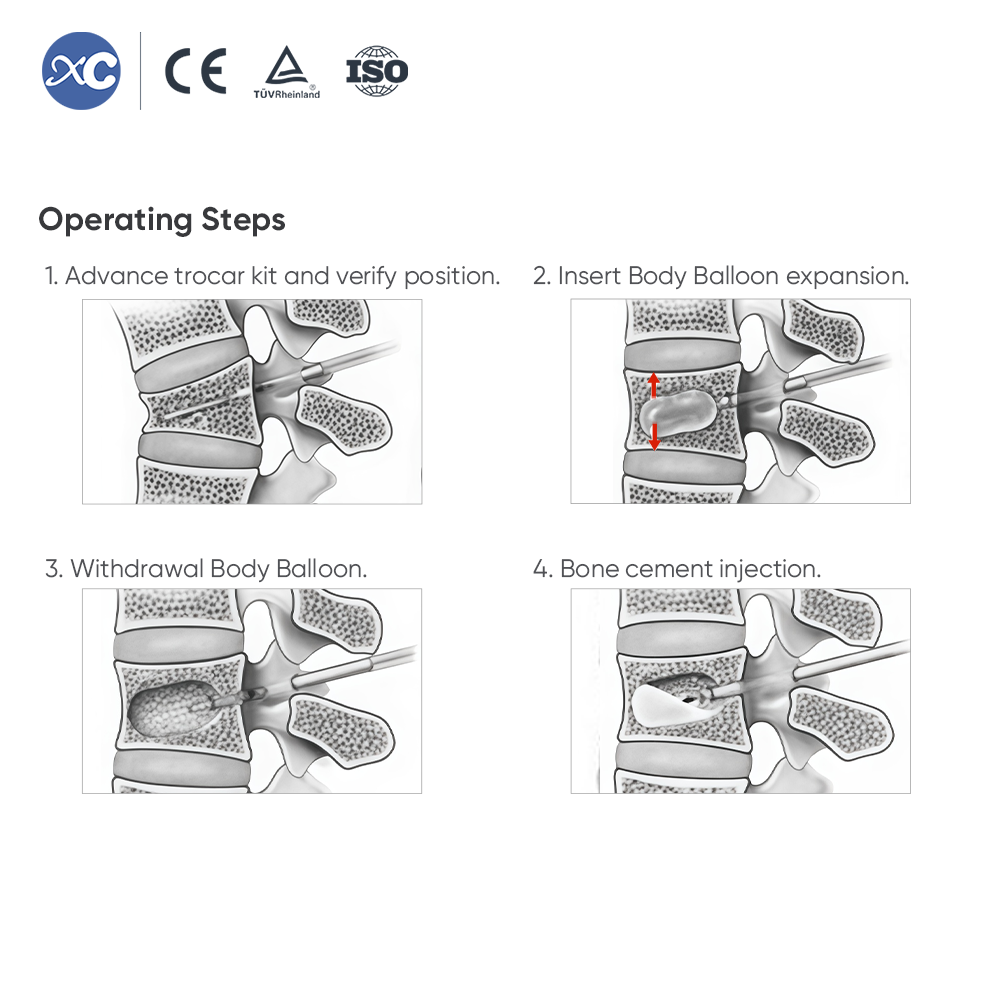 Система кифопластики (PKP/PVP) – набор баллонов и цемента для тела позвонка