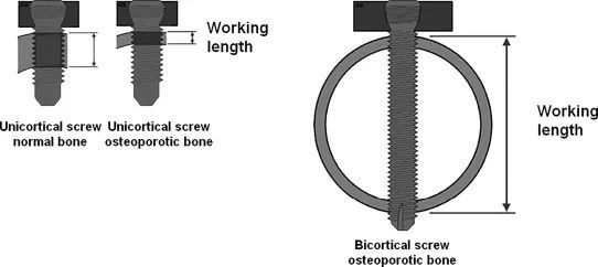 Запирающая пластина – Ограничения и ограничения по применению – 1