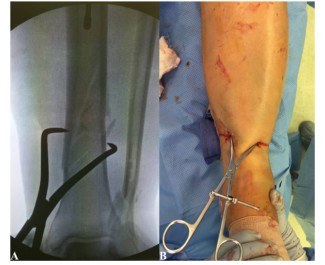 Техника фиксации интрамедуллярных гвоздей большеберцовой кости-7