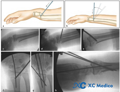 Дистальный радиус переломы-19