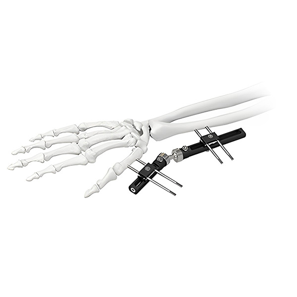 Внешний фиксатор запястья