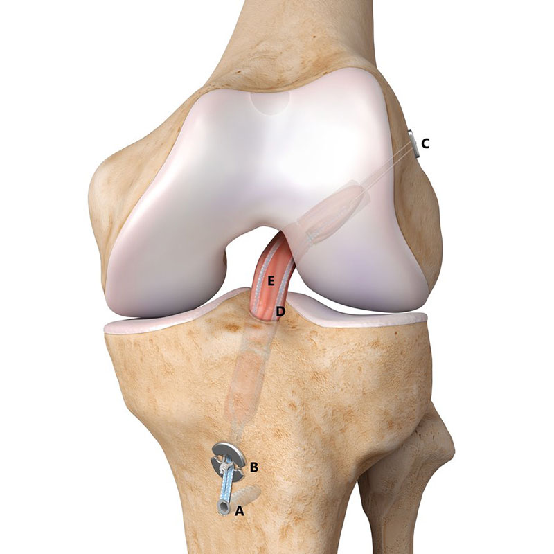 Реконструкция связок