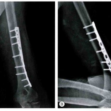 Как работают ортопедические имплантаты