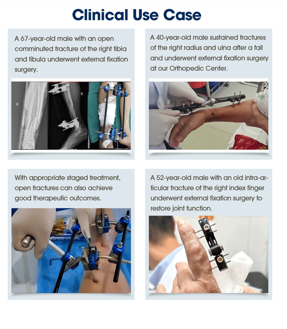  Внешний фиксатор для ноги — покупка продукта на XC Medico