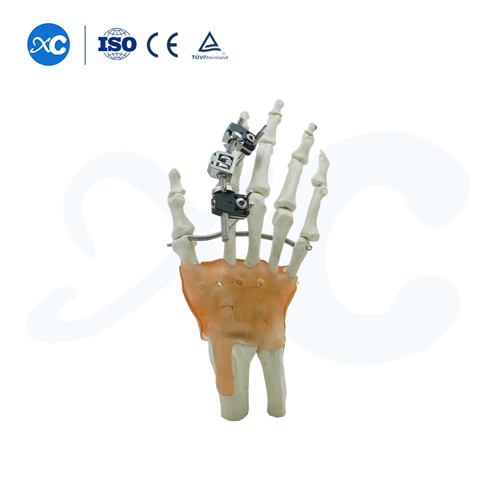 Внешняя фиксация пястных костей и фаланг