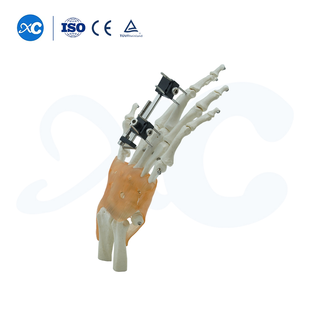 Универсальный компрессионный удлинитель мини-фиксатора