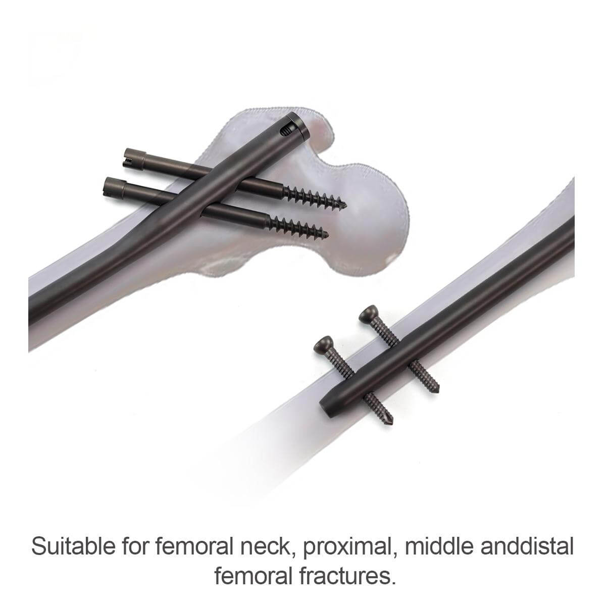 Гамма-интрамедуллярный стержень-3