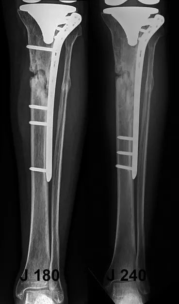 Запирающая пластина: ограничения и ограничения по применению-4