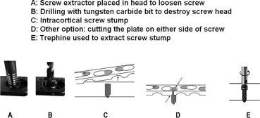 Запирающая пластина: ограничения и ограничения по применению-3