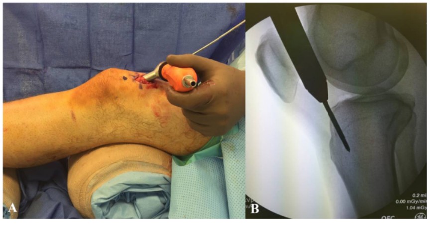Техника фиксации интрамедуллярных гвоздей большеберцовой кости-3