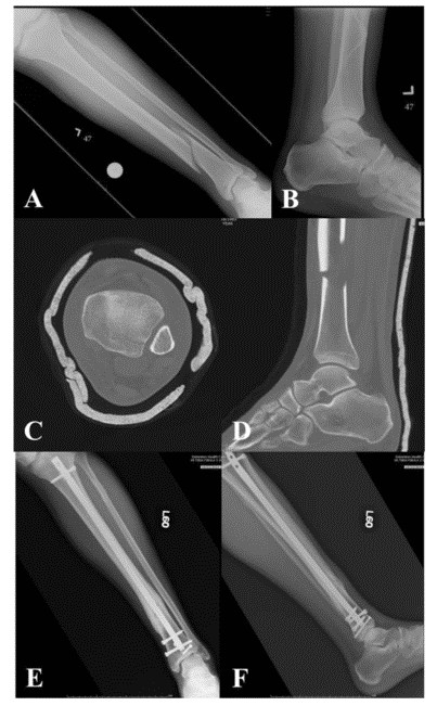 Техника фиксации интрамедуллярных гвоздей большеберцовой кости-2