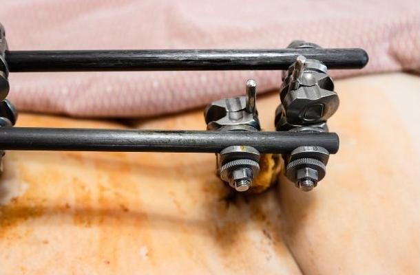 Баннер внешней фиксации-7