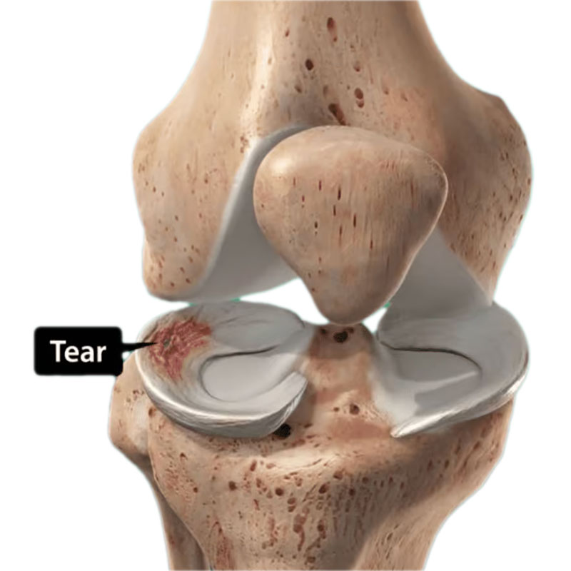 Ремонт мениска