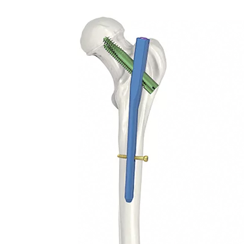 Интрамедуллярный гвоздь